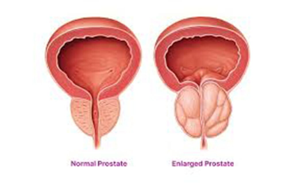 Prostate Health, Screening, and Awareness
